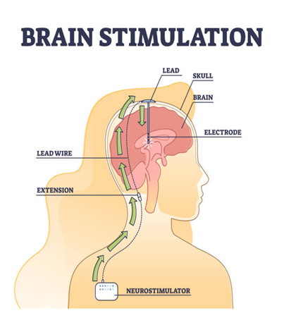 deep-brain-stimulation deep-brain-stimulation
