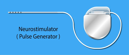 neurostimulator neurostimulator