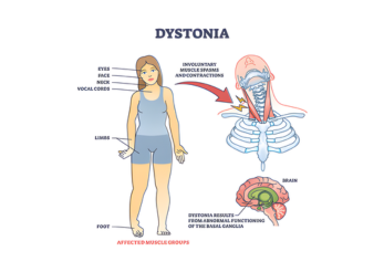 dystonia