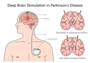Deep-Brain Stimulation Surgery
