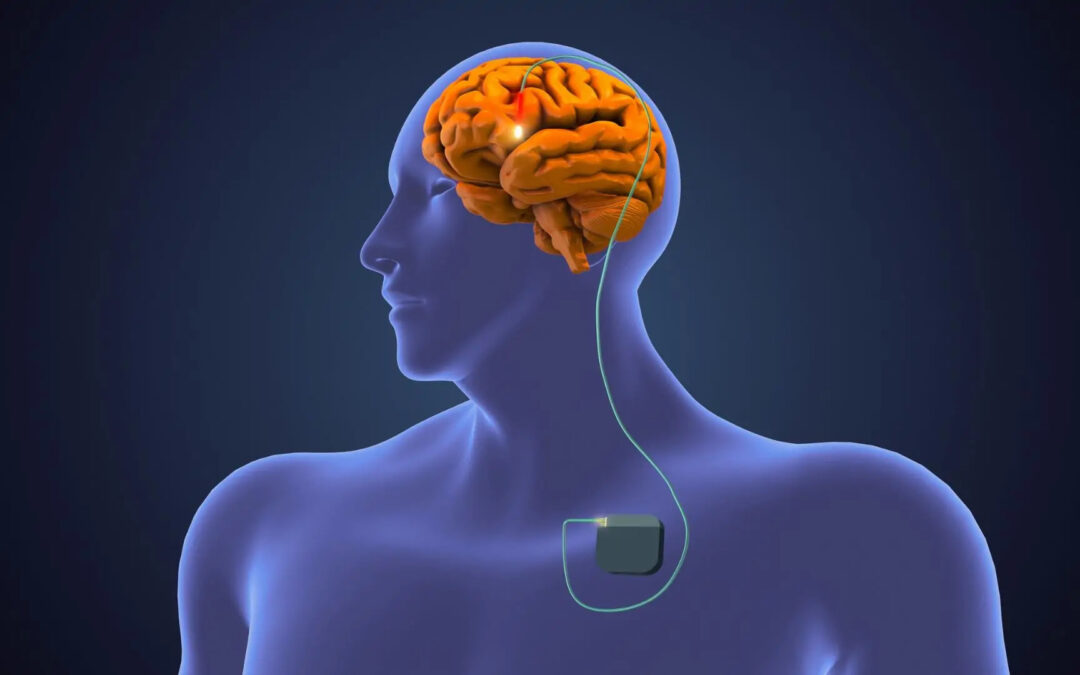 How Deep Brain Stimulation Works for Parkinson’s