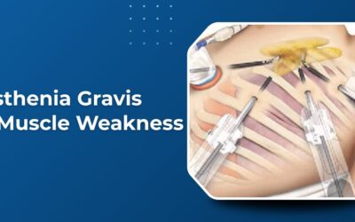 Myasthenia Gravis: Is Your Muscle Weakness Actually a Neurological Problem?