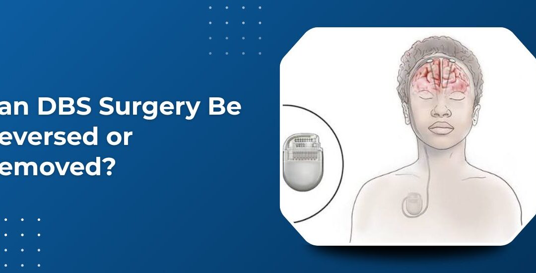 Can DBS Surgery Be Reversed or Removed at a Later Stage?