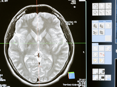 Â MRI or CT Imaging - drguruprasadhneuropdspecialist.com Deep-Brain Stimulation Surgery