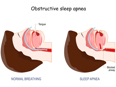 Â Obstructive and Central Sleep Apnea - drguruprasadhneuropdspecialist.com headaches-and-vertigo
